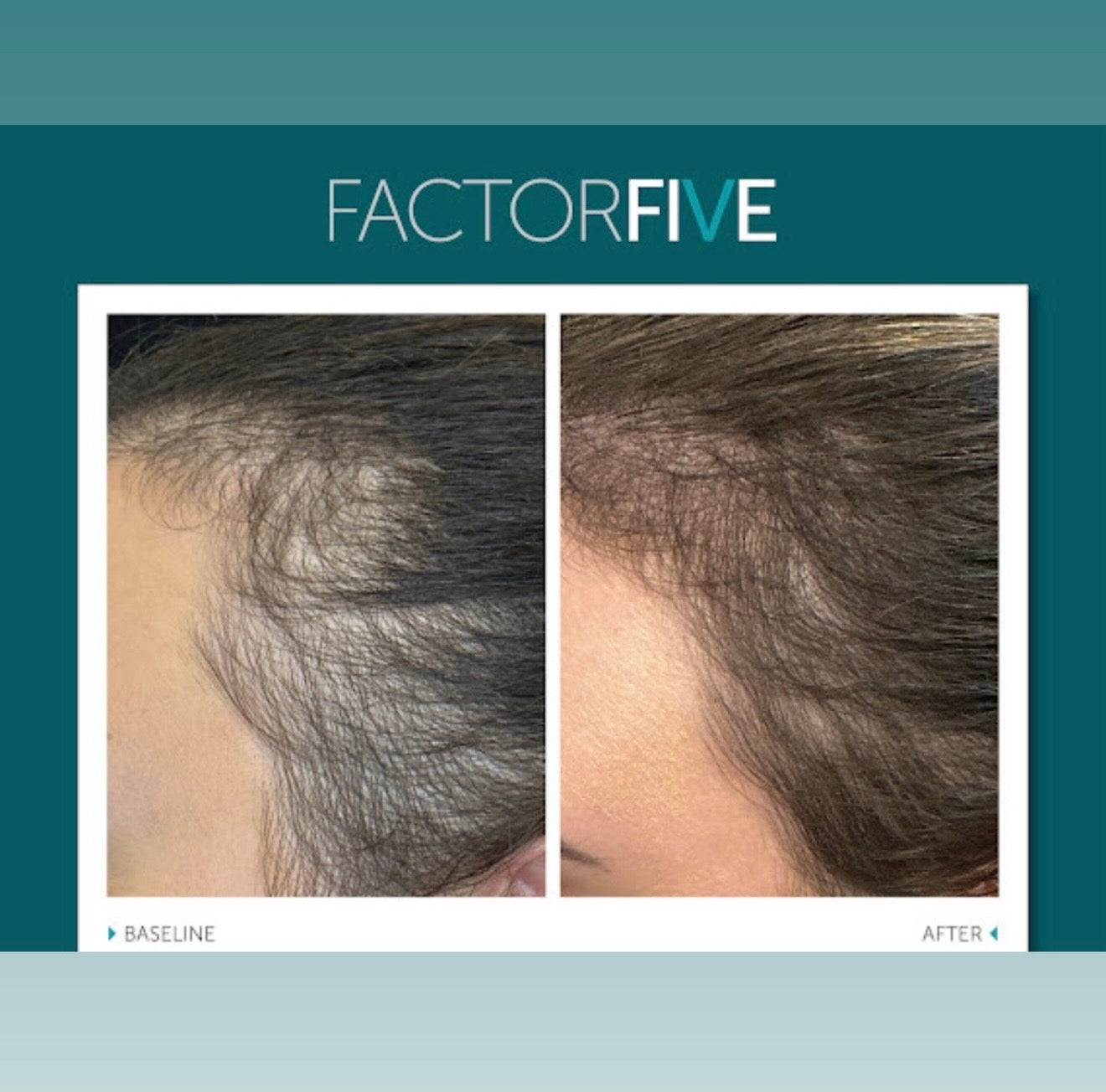 Factorfive Shampoo Advanced Haircare